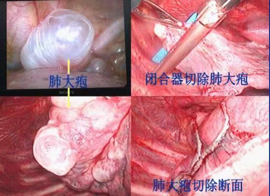 济宁市公共卫生医疗中心成功开展首例小切口胸腔镜下肺大泡切除术+胸膜固定术 济宁市公共卫生医疗中心成功开展首例小切口胸腔镜下肺大泡切除术+胸膜固定术