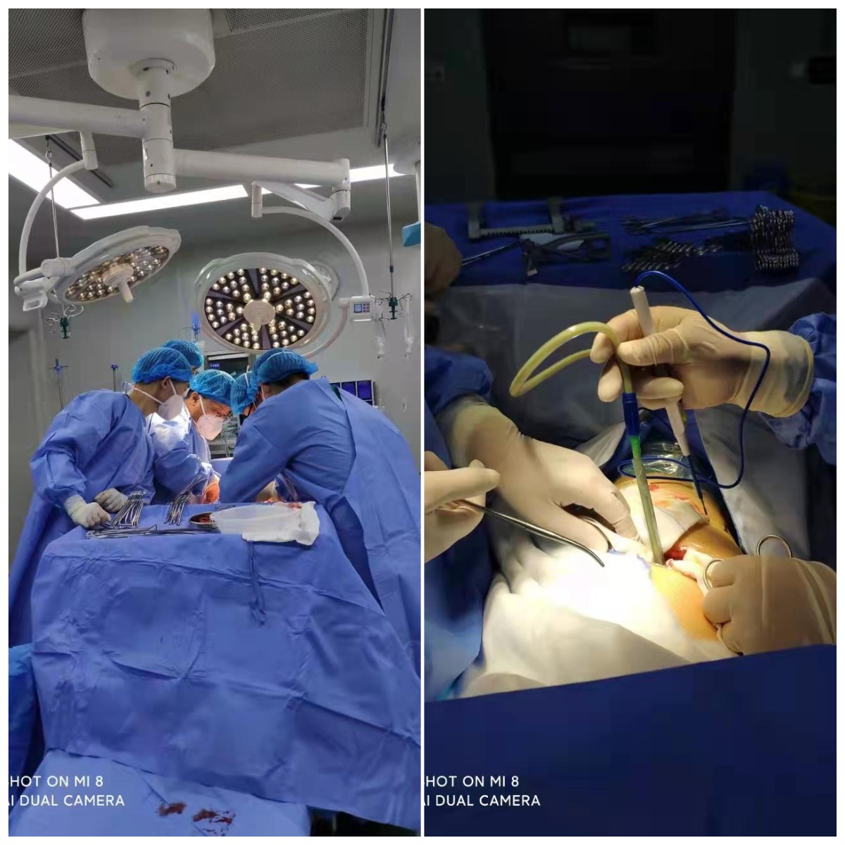 【公卫中心·诊疗新突破】我院成功开展胸膜腔纤维板剥脱术 【公卫中心·诊疗新突破】我院成功开展胸膜腔纤维板剥脱术