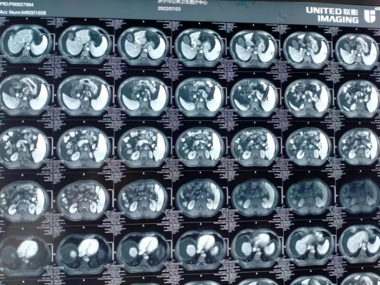 济宁市公共卫生医疗中心顺利完成一例高难度巨大脾脏切除术
