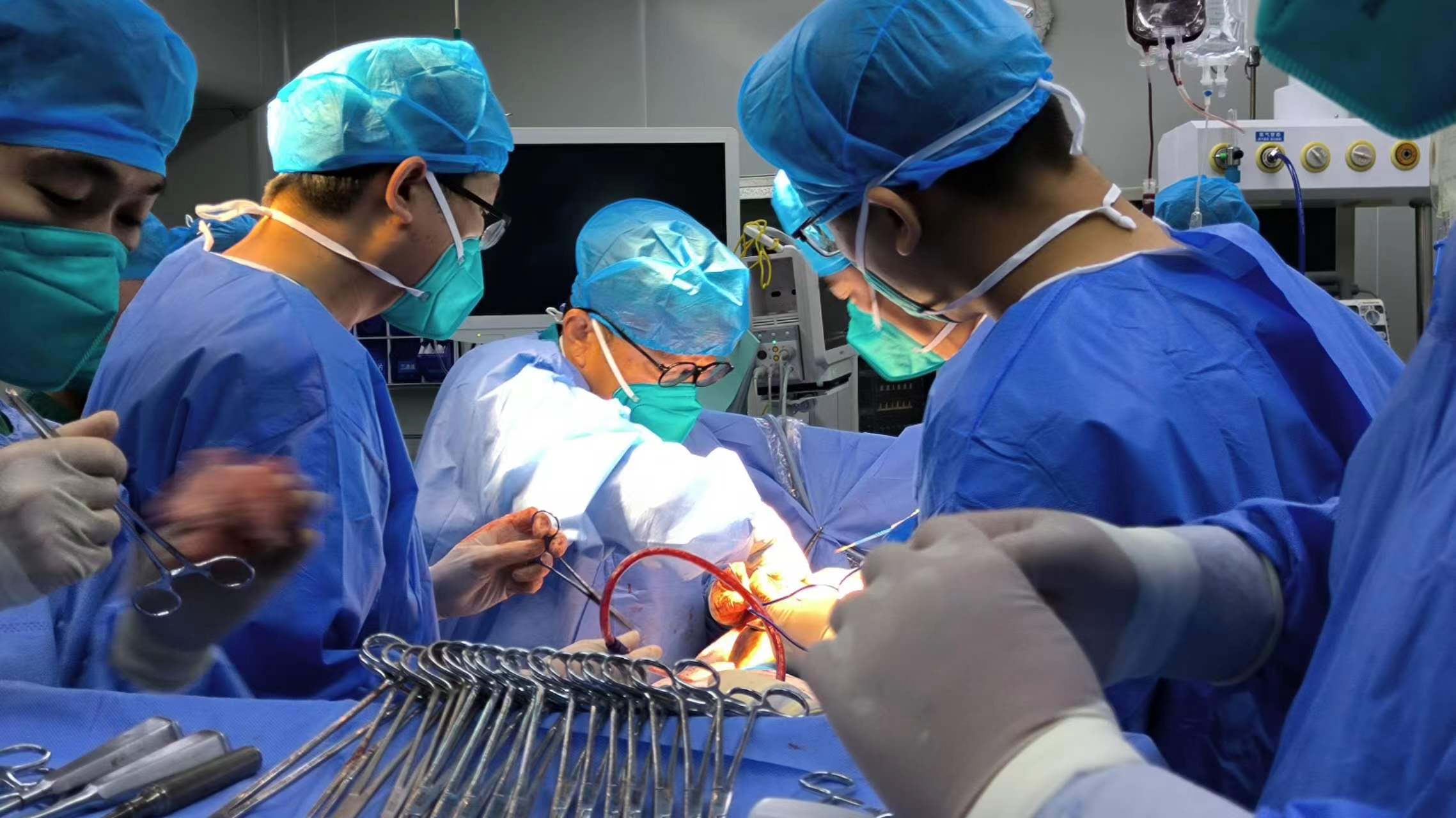 【公卫·技术】我院成功完成一例胸腔镜辅助小切口“右侧结核性脓胸胸膜纤维板剥脱+肺修补术”