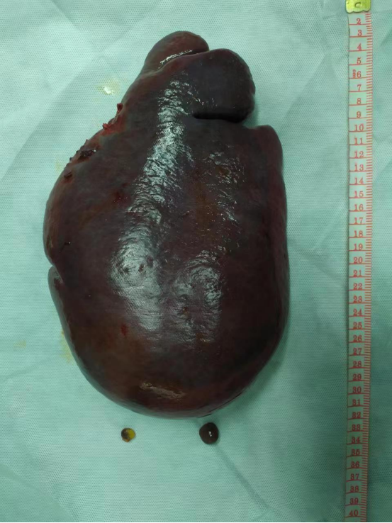 济宁市公共卫生医疗中心顺利完成一例高难度巨大脾脏切除术