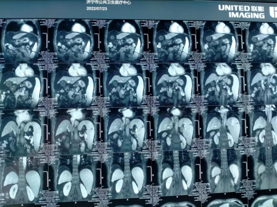 济宁市公共卫生医疗中心顺利完成一例高难度巨大脾脏切除术