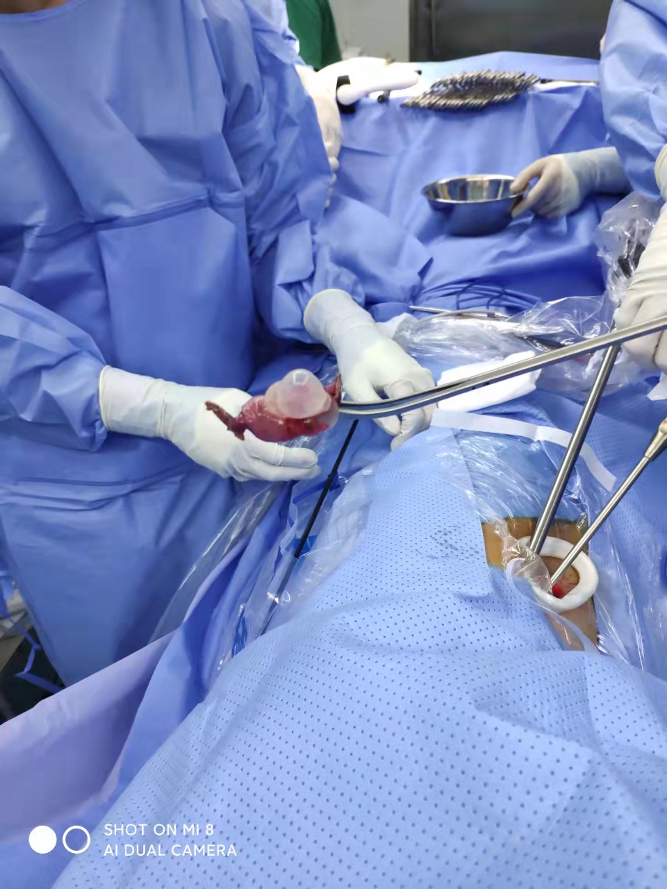 济宁市公共卫生医疗中心成功开展首例小切口胸腔镜下肺大泡切除术+胸膜固定术 济宁市公共卫生医疗中心成功开展首例小切口胸腔镜下肺大泡切除术+胸膜固定术