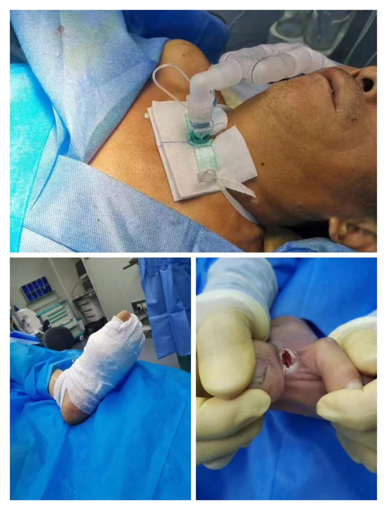 公卫医疗 | 济宁市公共卫生医疗中心成功救治一例重型破伤风患者